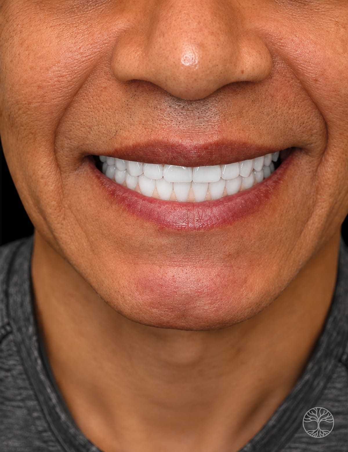 Full-arch dental implant smile restoration — after