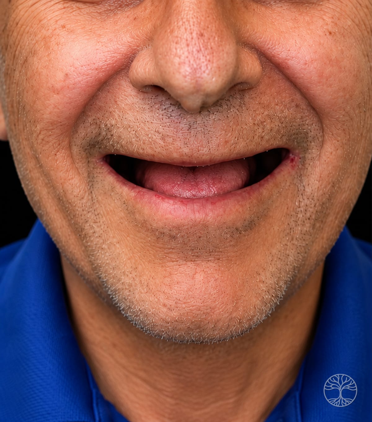 Full-arch dental implant smile restoration — before