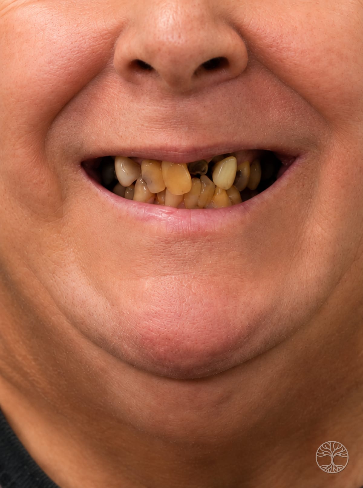 Full-arch dental implant smile restoration — before