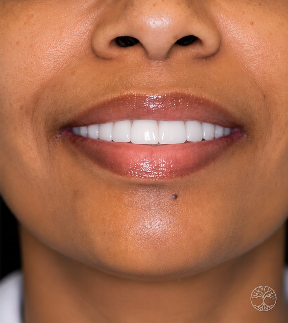 Full-arch dental implant smile restoration — after