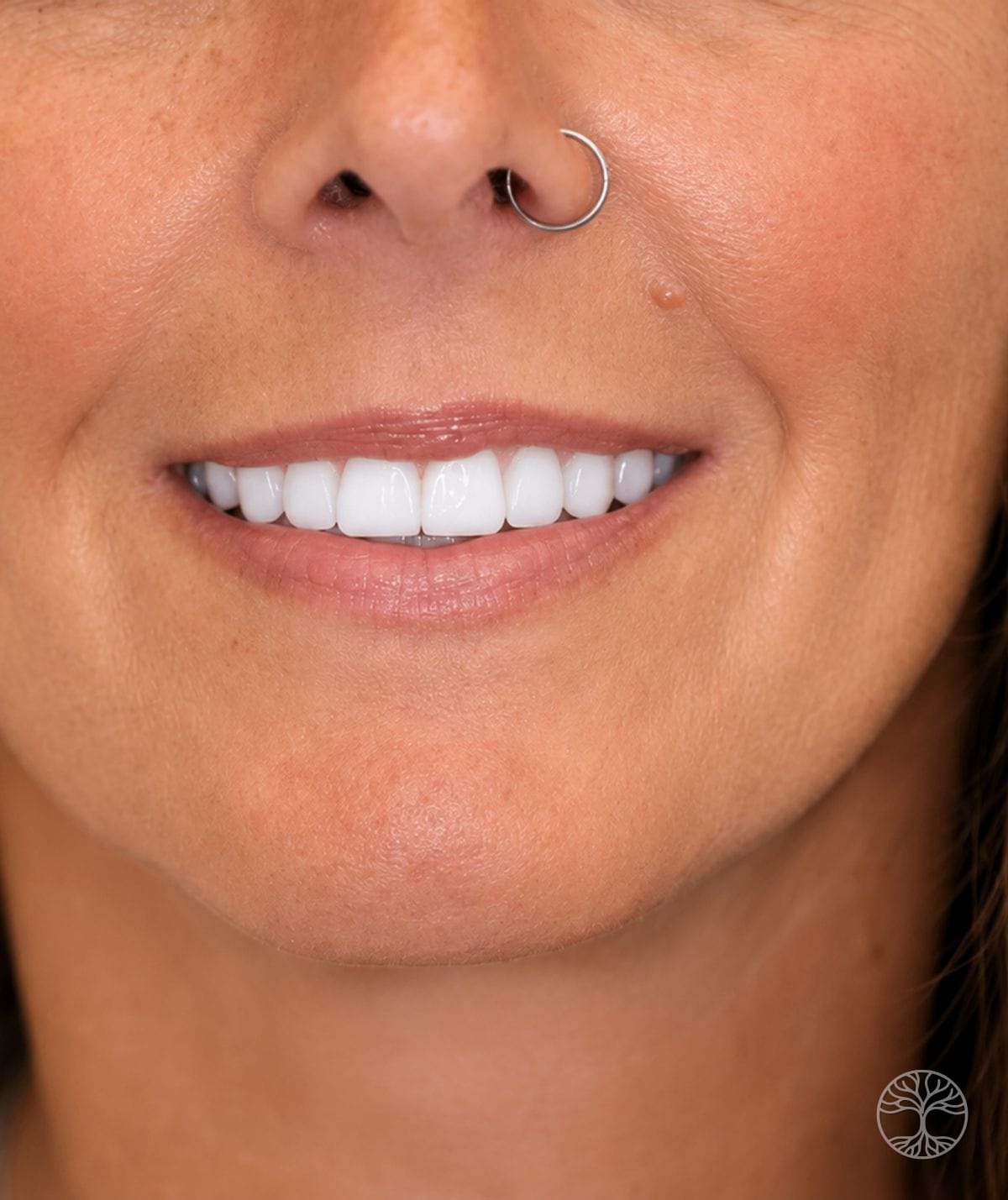 Full-arch dental implant smile restoration — after