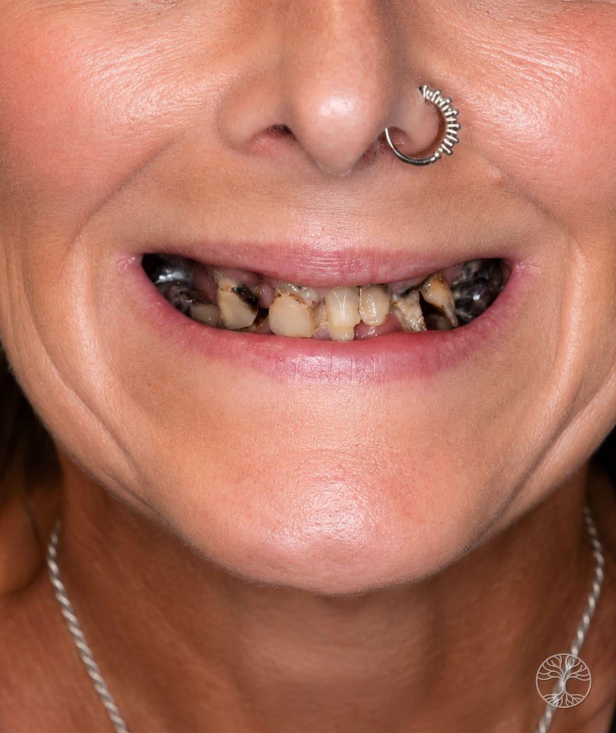 Full-arch dental implant smile restoration — before